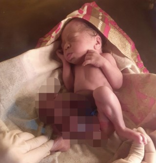 धादिङ बेनिघाट रोराङमा आन्द्रा बाहिर रहेको शिुशु जन्मियो, गाउँपालिकाले सम्पूर्ण उपचार खर्च व्यहोर्ने