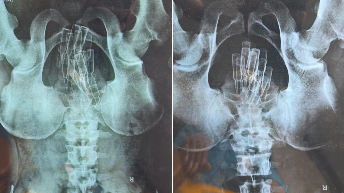 014338723xray.jpeg