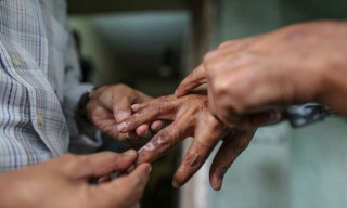 चितवनमा भेटिए १८ जना कुष्ठरोगी